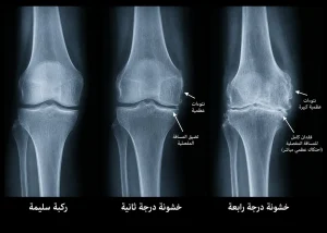 اشعة ركبة سليمة مقارنة بخشونة الركبة على الأشعة السينية