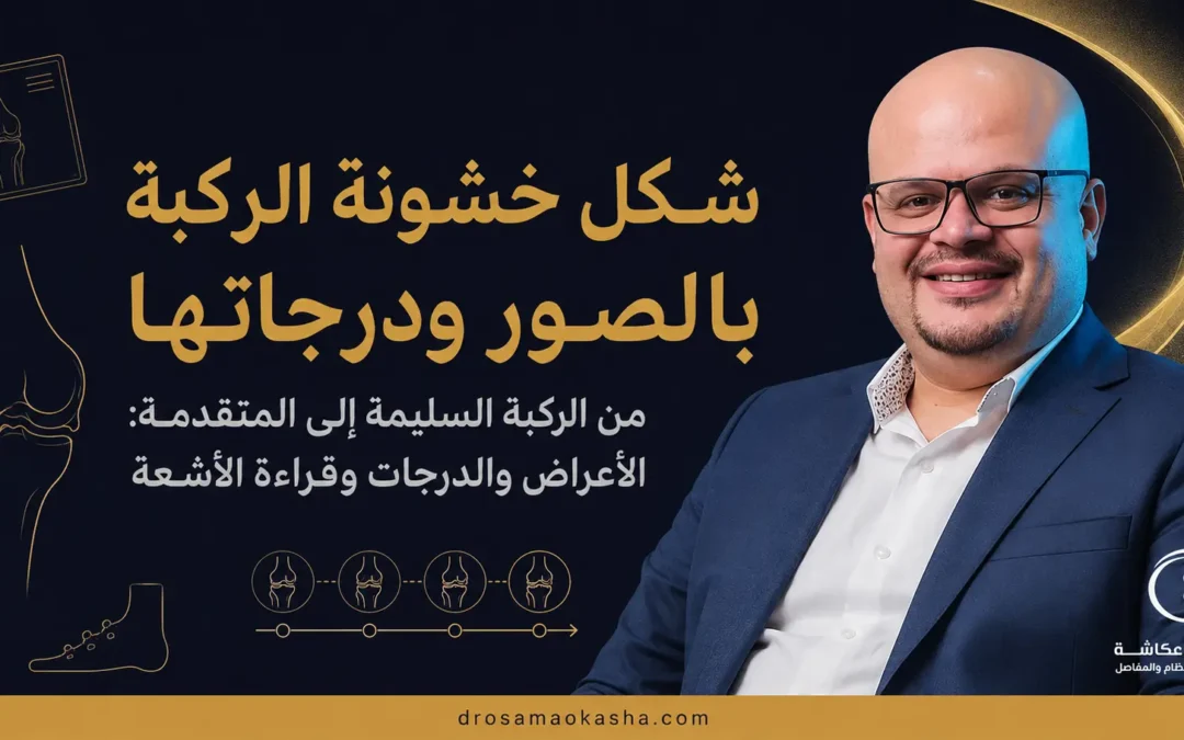 شكل خشونة الركبة بالصور ودرجاتها: من الركبة السليمة إلى المتقدمة