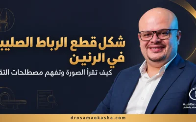 شكل قطع الرباط الصليبي في الرنين: كيف تقرأ الصورة والتقرير؟