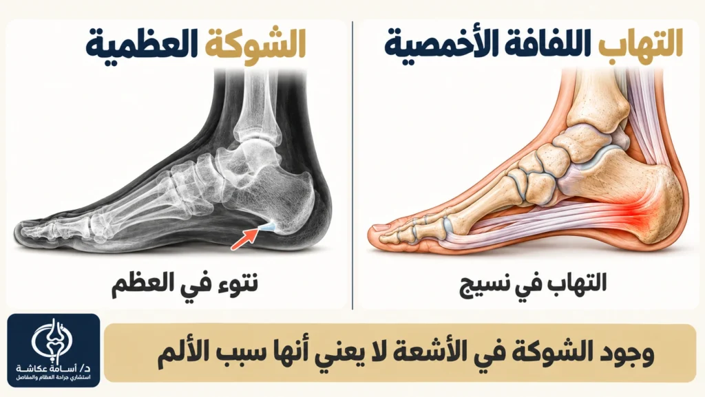 الفرق بين الشوكة العظمية في الأشعة والتهاب اللفافة الأخمصية عند الكعب